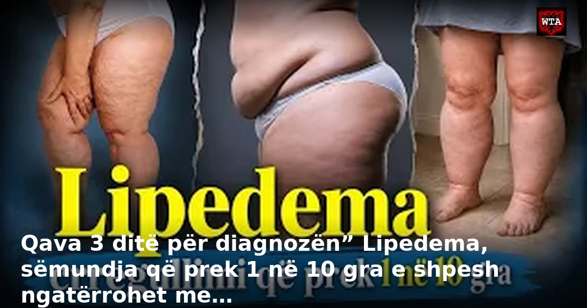 Qava 3 ditë për diagnozën” Lipedema, sëmundja që prek 1 në 10 gra e shpesh ngatërrohet me…